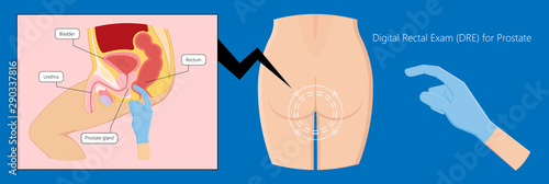 Transurethral resection of the prostate stricture urine bladder digital rectal exam specific antigen Gleason score biopsies Prostatitis test blood ultrasonography Radical Prostatectomy