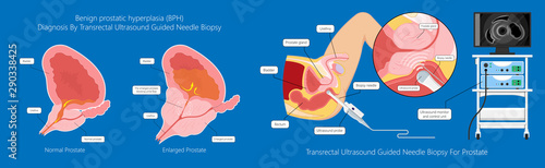 Transurethral resection of the prostate stricture urine bladder digital rectal exam specific antigen Gleason score biopsies Prostatitis test blood ultrasonography Radical Prostatectomy