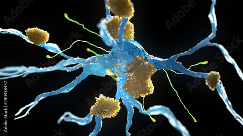 3d rendered medical illustration of nerve cells suffering from alzheimer disease