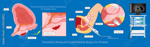 Transurethral resection of the prostate stricture urine bladder digital rectal exam specific antigen Gleason score biopsies Prostatitis test blood ultrasonography Radical Prostatectomy