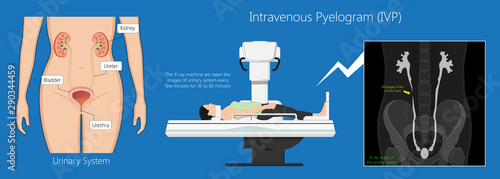Intravenous pyelogram IVP examination x-ray for bladder kidney ureters disease problem