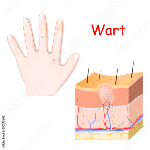 warts on a hand. cross section of detailed wart