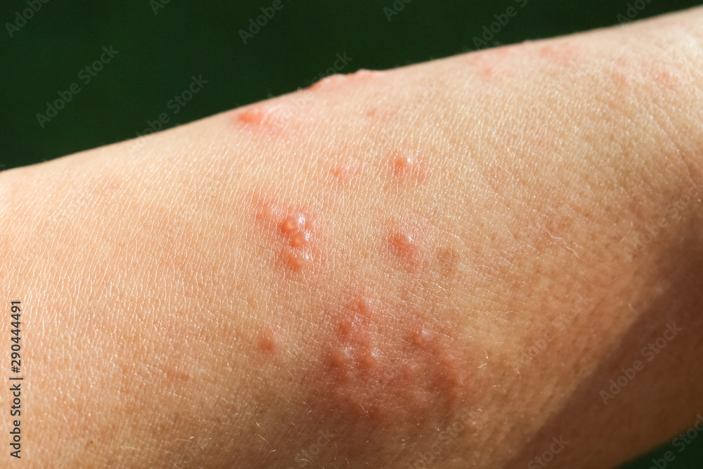 skin rash as allergic symptoms due to arm fiberglass cast skin rash as allergic symptoms due to arm fiberglass cast