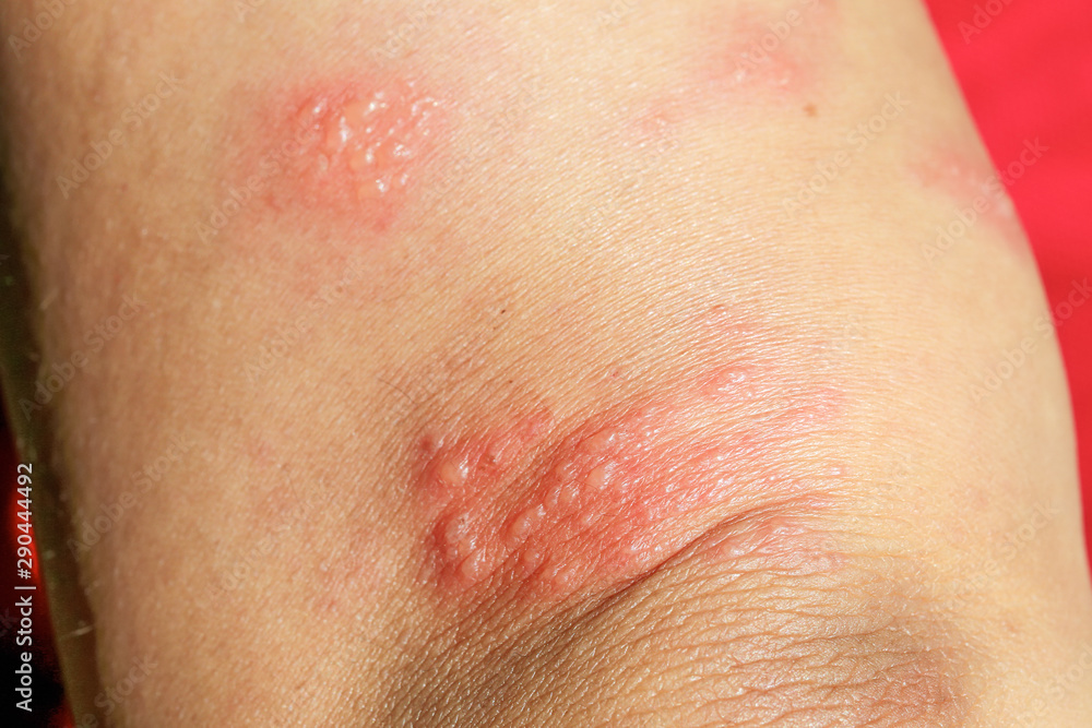 skin rash as allergic symptoms due to arm fiberglass cast skin rash as allergic symptoms due to arm fiberglass cast