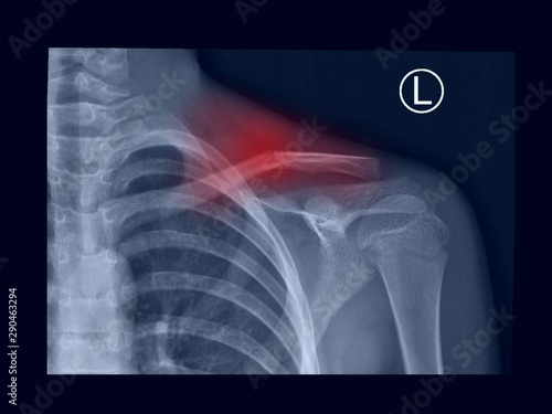 Принти на полотні film x-ray shoulder radiograph show fracture clavicle (collar bone) after trauma accident