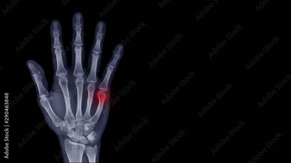 Film Xray hand radiograph show finger bone broken (fifth metacarpal