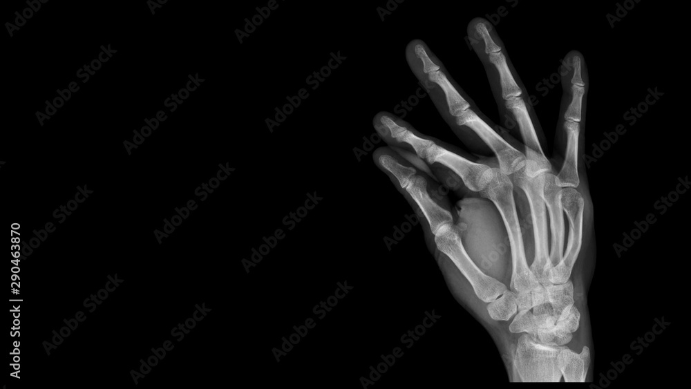 Film X ray hand radiograph show hand bone broken (fifth metacarpal fracture or Boxer's fracture) from traffic accident. The patient has hand pain and deformity. Medical imaging and technology concept