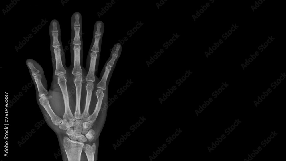 Film X ray hand radiograph show hand bone broken (fifth metacarpal fracture or Boxer's fracture) from sport injury. Patient has hand pain and deformity. Medical imaging and technology concept