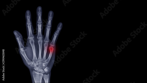 Film X-ray hand radiograph show finger bone broken (fifth metacarpal fracture or Boxer's fracture) from sport injury. Highlight on fracture site and painful area. Medical imaging concept 