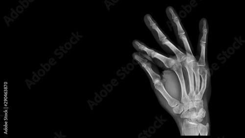 Film X ray hand radiograph show hand bone broken (fifth metacarpal fracture or Boxer's fracture) from traffic accident. The patient has hand pain and deformity. Medical imaging and technology concept photo