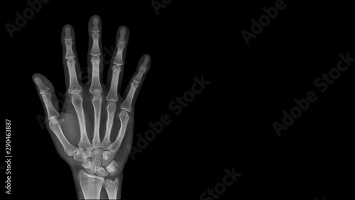 Film X ray hand radiograph show hand bone broken (fifth metacarpal fracture or Boxer's fracture) from sport injury. Patient has hand pain and deformity. Medical imaging and technology concept