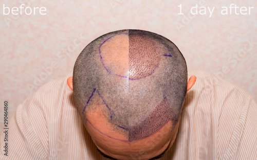 Before and after hair transplant surgery with a receding hair line. Bald head of hair loss treatment. photo