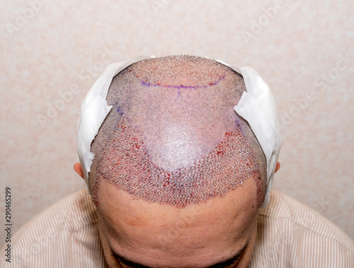 Top view of a man's head with hair transplant surgery with a receding hair line. Bald head of hair loss treatment.