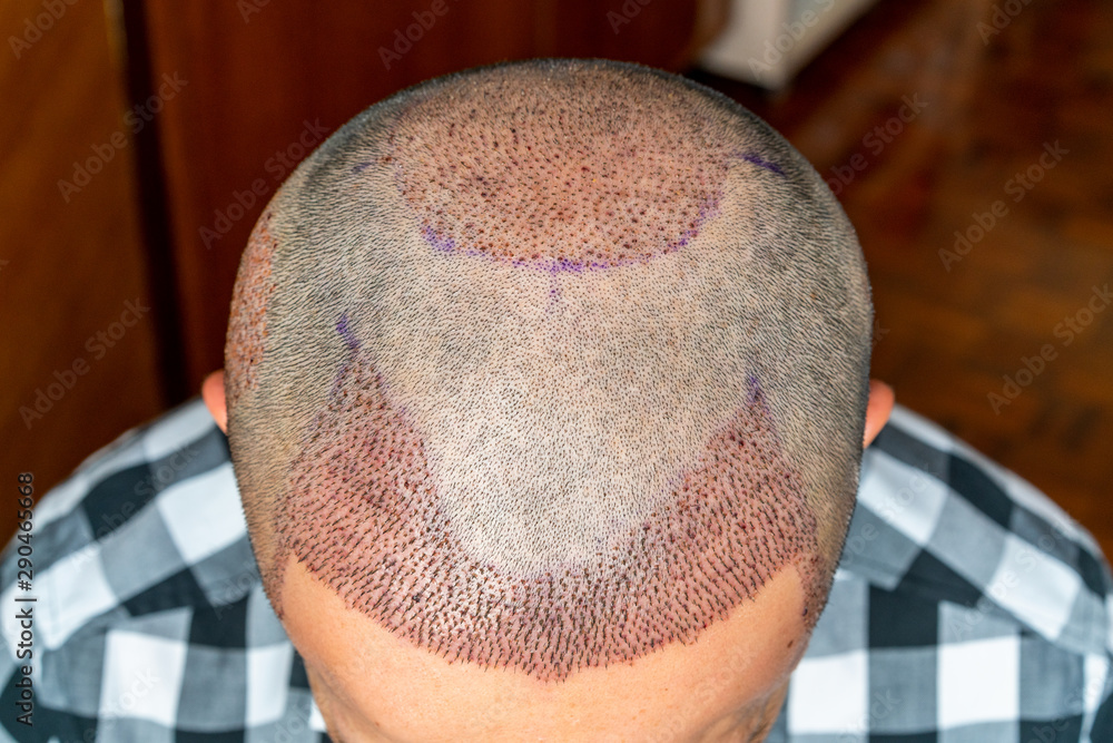 Top view of a man's head with hair transplant surgery with a receding hair  line. Bald head of hair loss treatment. Stock Photo | Adobe Stock