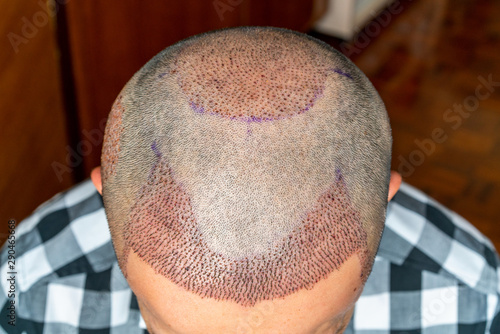 Top view of a man's head with hair transplant surgery with a receding hair line. Bald head of hair loss treatment.