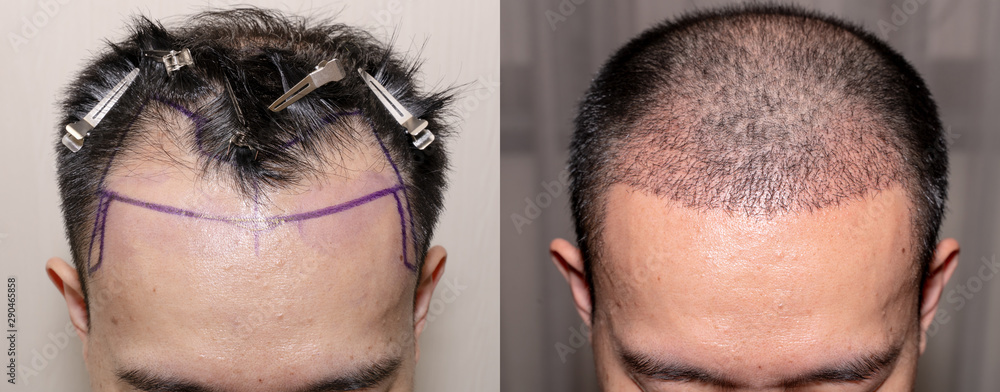Top view of a man's head with hair transplant surgery with a receding hair  line. - Before and After Bald head of hair loss treatment. Stock Photo |  Adobe Stock