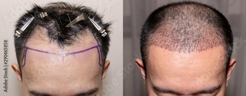 Top view of a man\'s head with hair transplant surgery with a receding hair line. - Before and After Bald head of hair loss treatment.