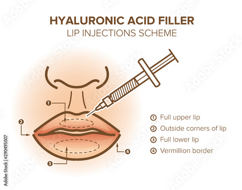 Hyaluronic acid filler. Lip injections sheme poster. Before and after. Vector illustration