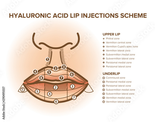 Hyaluronic acid filler. Lip injections. Lip anatomy poster