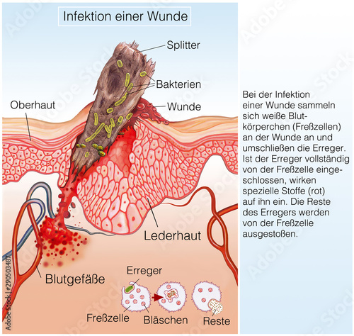 Infektion einer Wunde.Fremdkörper in der Haut