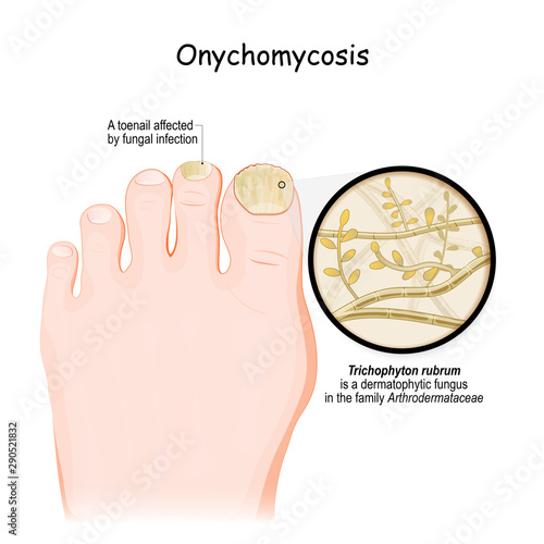 fungal infection of the nail. close-up of A toenail affected by dermatophytic fungus photo