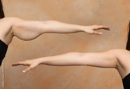 A before and after comparison of a young Caucasian woman who had a brachioplasty. Corrective arm lift surgery which removes the sagging fat layer from the triceps area.