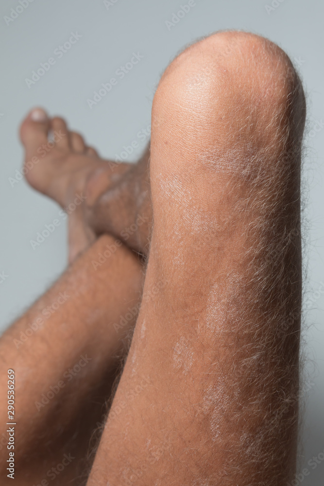 Fototapeta premium Large plaque parapsoriasis on caucasian man legs