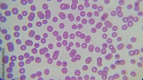blood smear : Red blood cells from a dog suspected of babesiosis under a microscope	