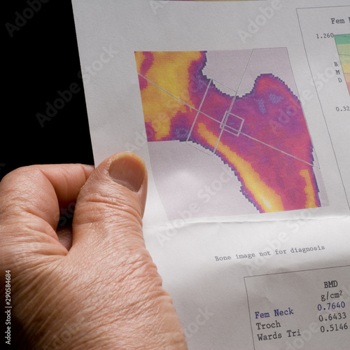 A hand of an old woman holding a printed paper with osteoporosis test results