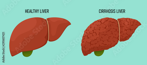 Healthy and cirrhous liver in cartoon flat style. Vector illustration for mecina, web, study guides, posters, magazines, advertising.