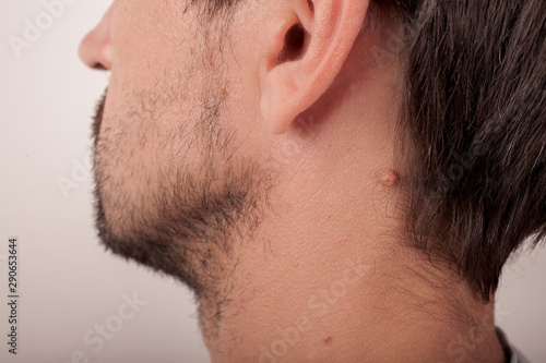 Adult man with moles on his neck photo