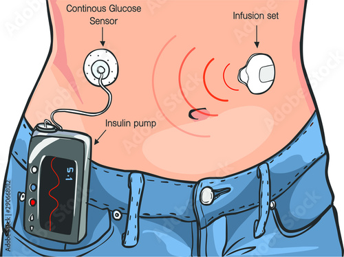 Insulin Pumps for Diabetes Patients Vector İllustration