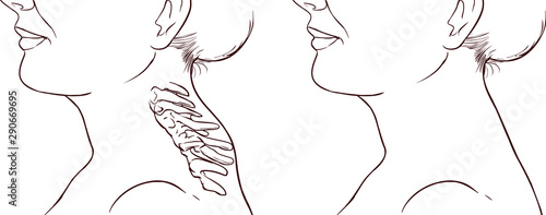 Woman Symptom Buffalo Hump Illustration
