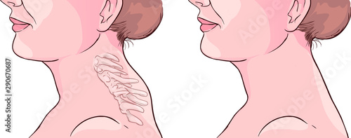 Woman Symptom Buffalo Hump Illustration