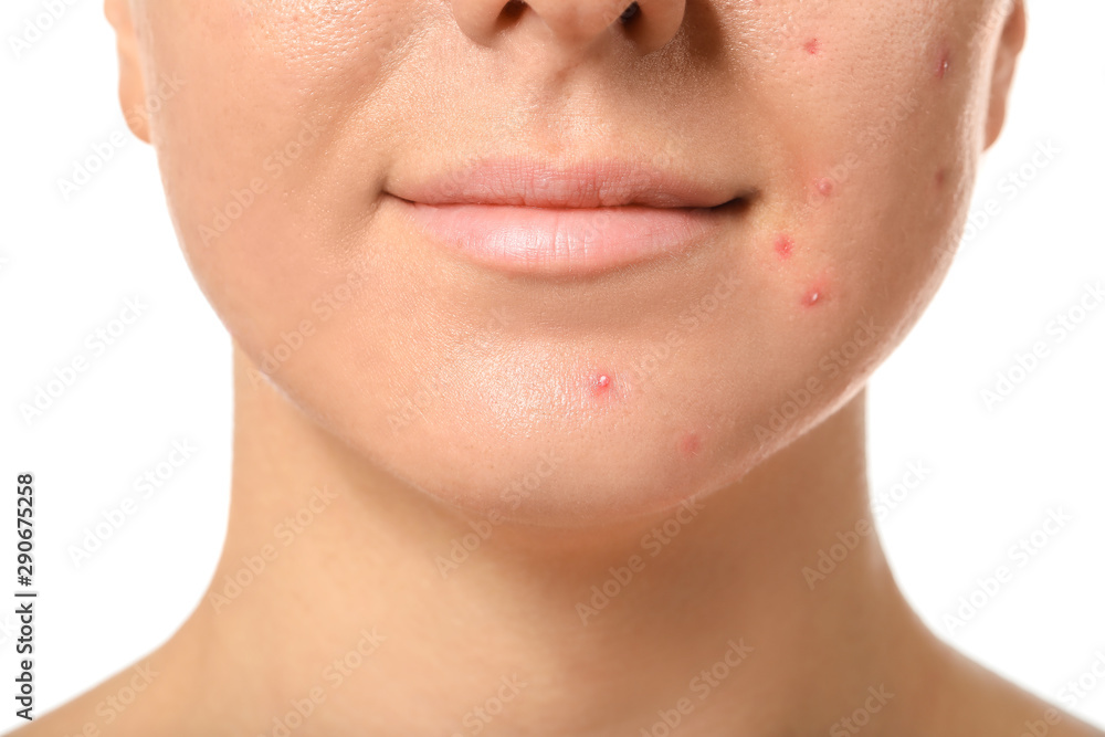 Obraz premium Young woman with acne problem on white background, closeup