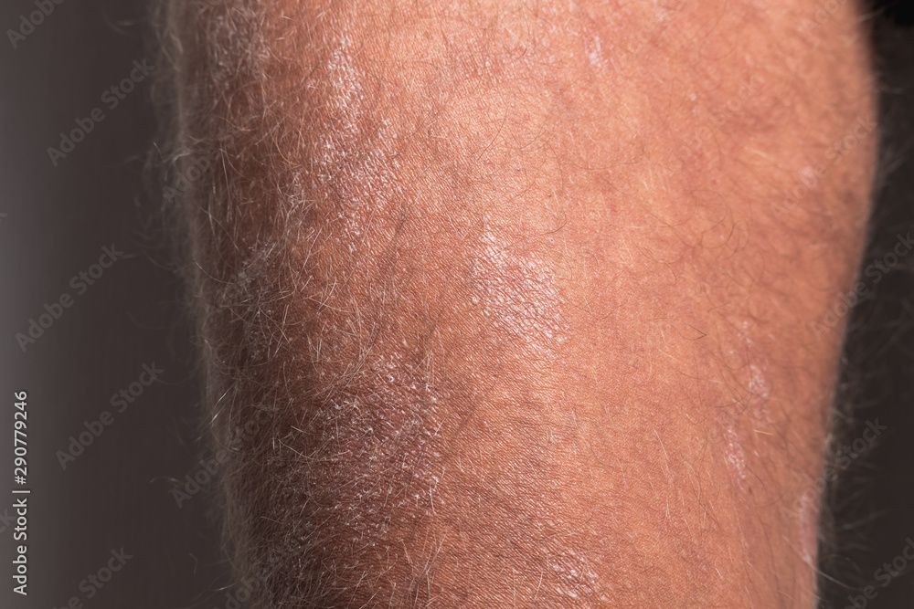 Fototapeta premium Large plaque parapsoriasis on caucasian man legs