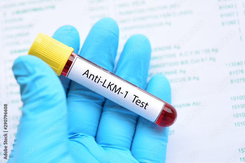 Blood sample for Anti-Liver Kidney Microsomal or Anti-LKM test Blood sample for Anti-Liver Kidney Microsomal or Anti-LKM test