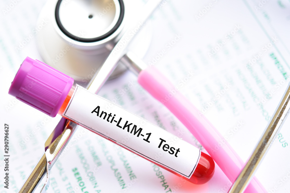 Blood sample for Anti-Liver Kidney Microsomal or Anti-LKM test Blood sample for Anti-Liver Kidney Microsomal or Anti-LKM test