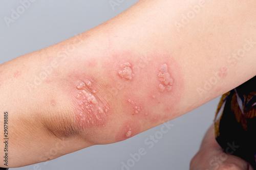 Photography Shingles, Zoster or Herpes Zoster symptoms on arm