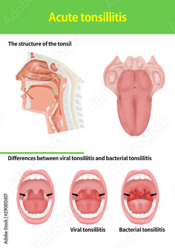 acute tonsillitis medical illust