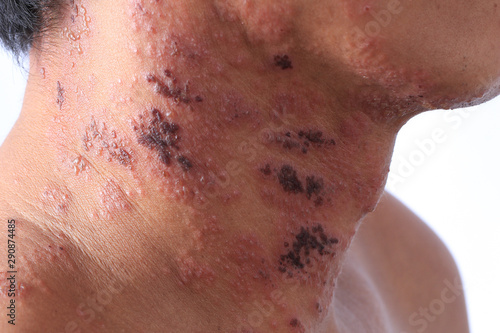 Tableau sur toile Herpes zoster or Shingles or Zoster infected by Varicella Zoster Virus or VZV