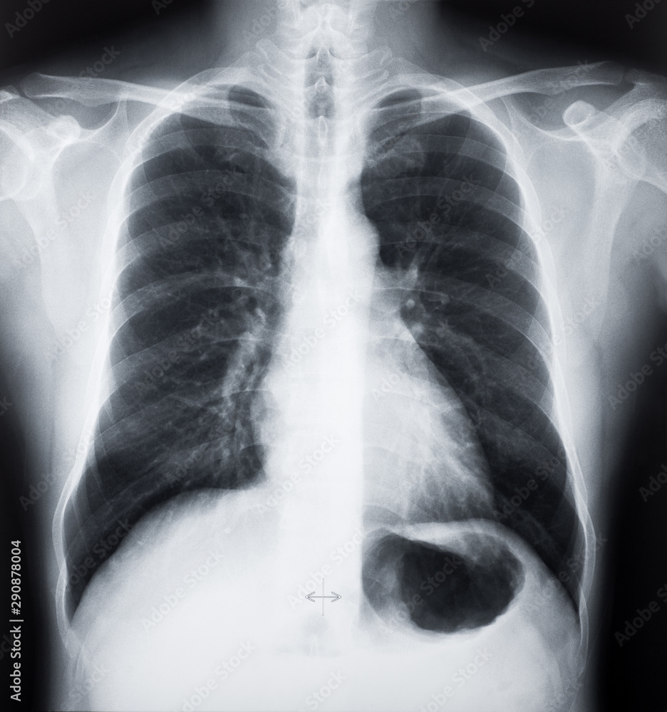 X-ray images of Human chest or lung. CT Scan Film. X-ray images of Human chest or lung. CT Scan Film.