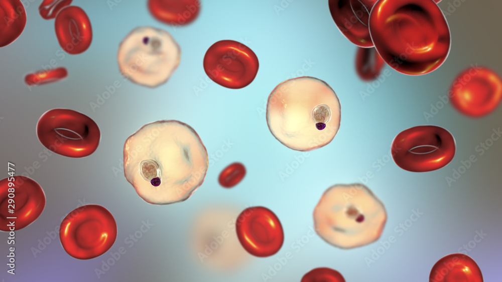 Blood smear in malaria patient. Plasmodium vivax inside red blood cell