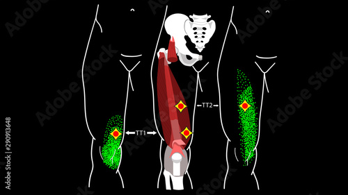 Vastus Medialis Trigger Points. Leg pain. Release photo