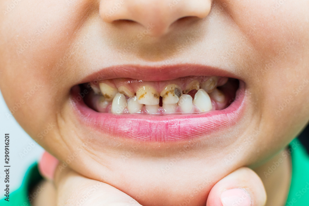 caries in the child. teeth with caries closeup. primary teeth. Stock