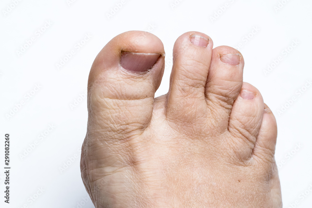 Ugly, Dirty, Weird toes. Close up on white background Ugly, Dirty, Weird toes. Close up on white background
