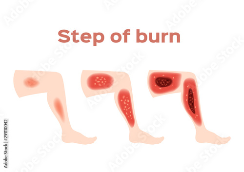 step of burn . Normal to serious burn skin . vector and icon / leg
