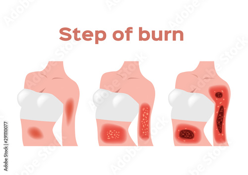 step of burn . Normal to serious burn skin . vector and icon / body chest and arm