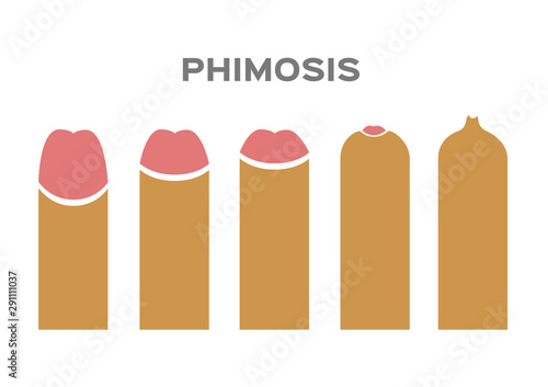 phimosis type vector on white background