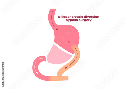 biliopancreatic diversion bypass surgery vector